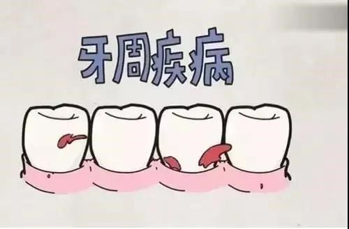 牙周炎